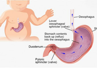 Refluksi Gastroezofageal tek fëmijët